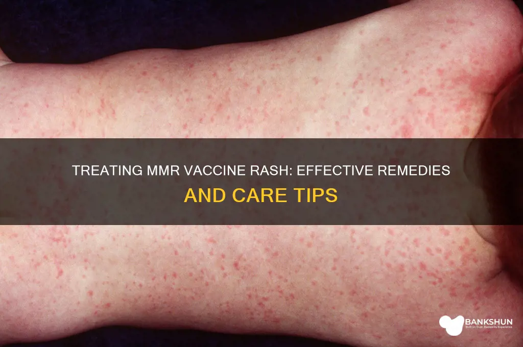 how to treat rash from mmr vaccine