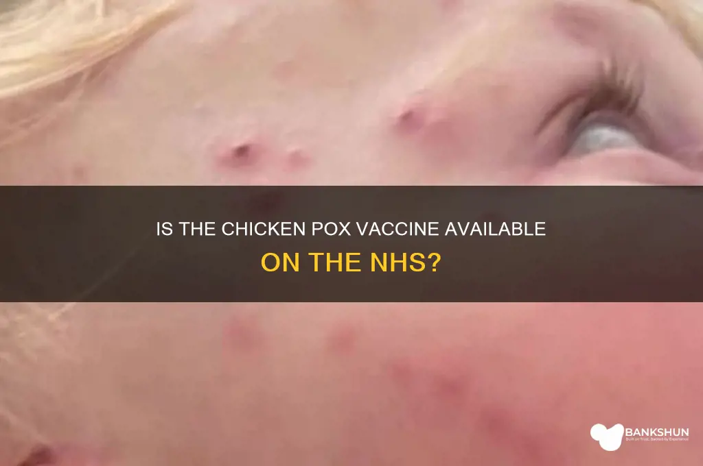is chicken pox vaccine available on nhs