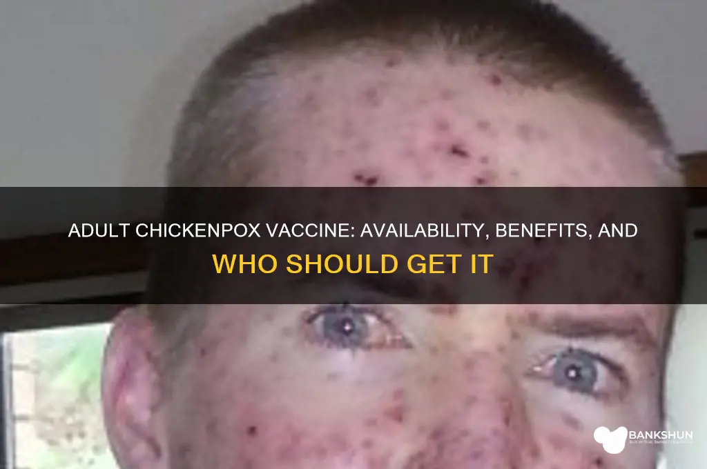 is there a chickenpox vaccine for adults