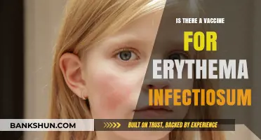 Erythema Infectiosum Vaccine: Current Status and Prevention Strategies