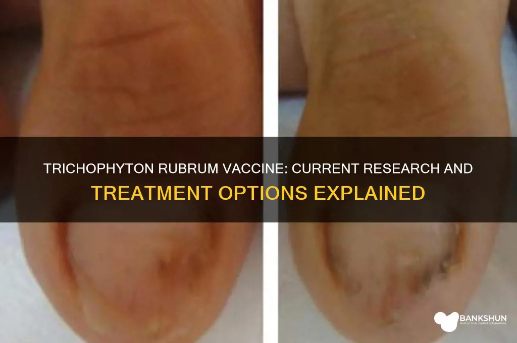 is there a vaccine for trichophyton rubrum
