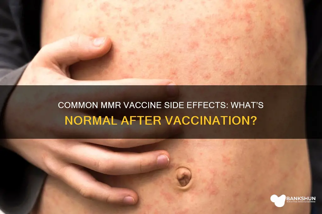 what are normal symptoms after mmr vaccine