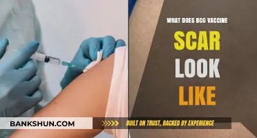 Understanding the Appearance of BCG Vaccine Scars: A Visual Guide