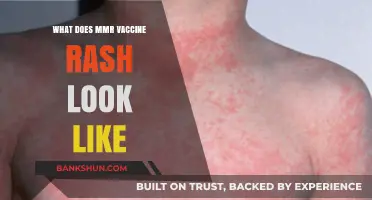 MMR Vaccine Rash: Appearance, Symptoms, and What to Expect