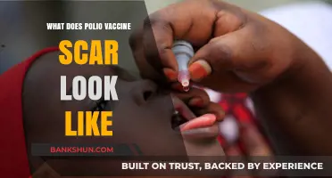 Understanding the Appearance of Polio Vaccine Scars: A Visual Guide