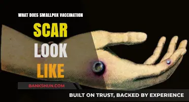 Smallpox Vaccination Scar: Appearance, History, and Identification Guide