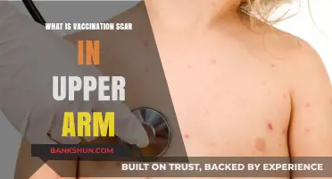 Understanding the Smallpox Vaccination Scar on Your Upper Arm