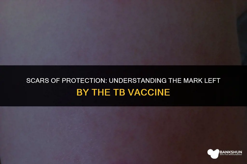 what mark does the tb vaccine leave