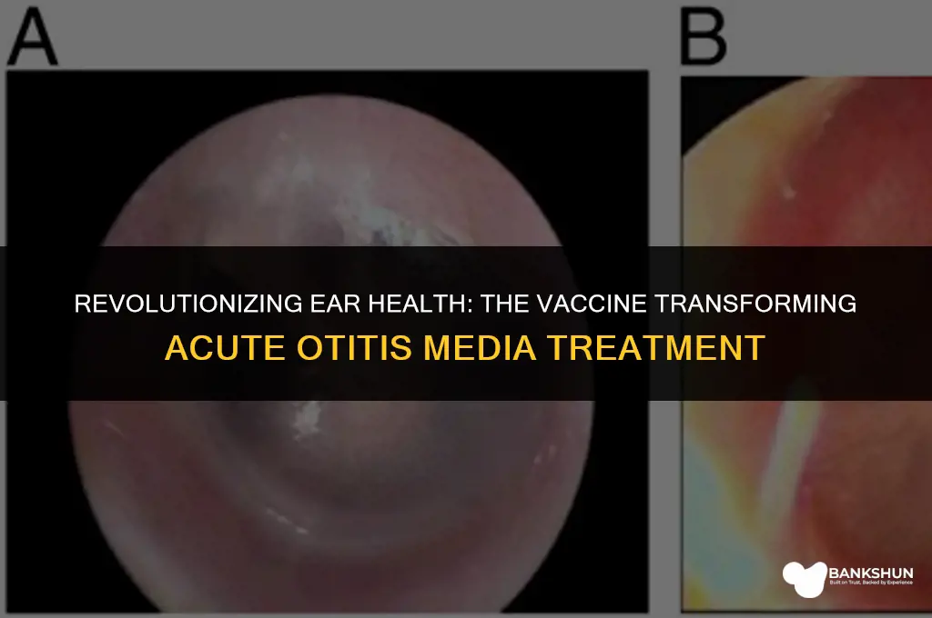 which vaccine is changing acute otitis media